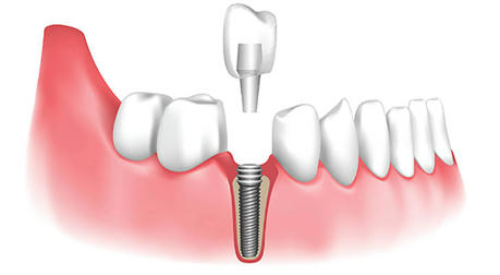 Regain a confident smile: How dental implants change your life